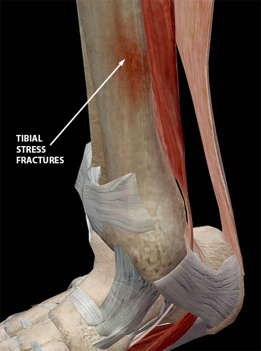Hold on to Your Tibias The Anatomy and Causes of Shin Splints